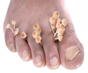 как правильно лечить грибок ногтей +на ногах